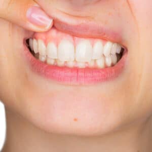 Full Dental Implants