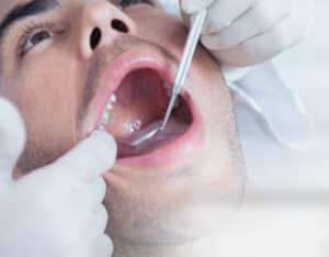 Implant retained dentures