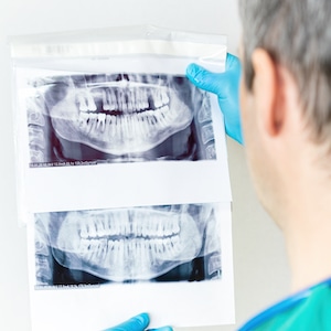 Pterygoid Implants