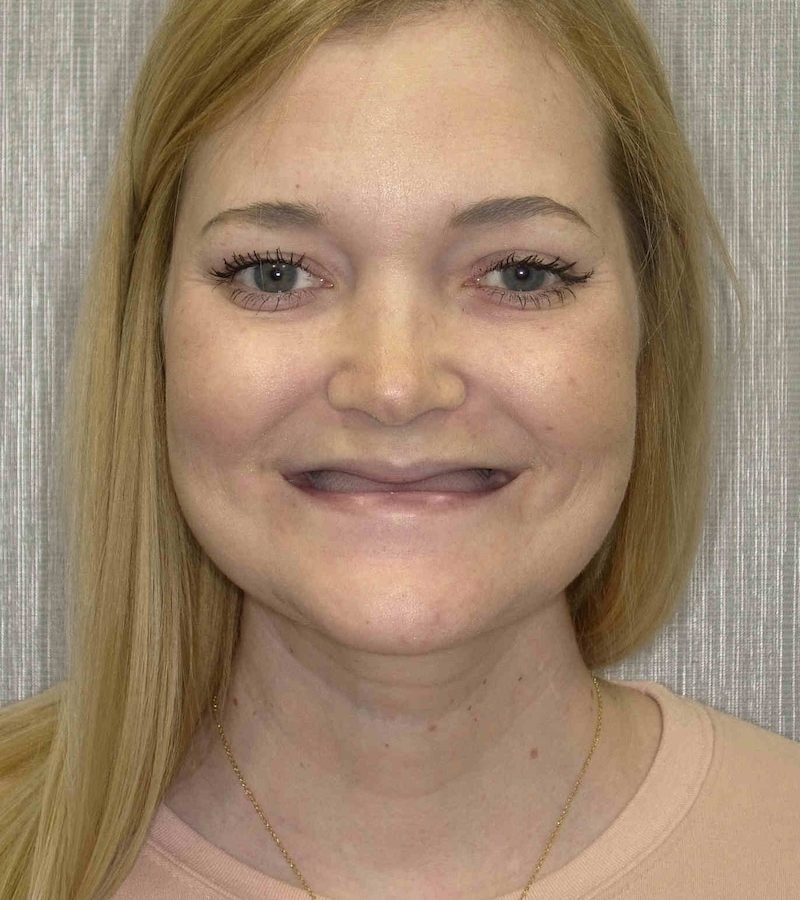Before Before Zygomatic Implant